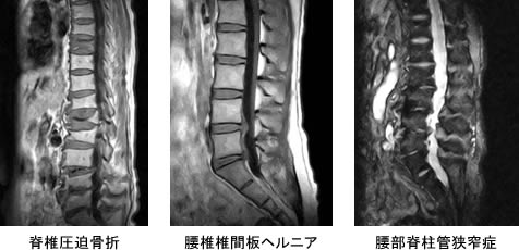 脊椎圧迫骨折 腰椎椎間板ヘルニア 腰部脊柱管狭窄症