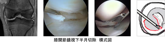 膝関節鏡視下半月切除 模式図