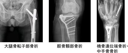 大腿骨転子部骨折 脛骨顆部骨折 橈骨遠位端骨折・中手骨骨折